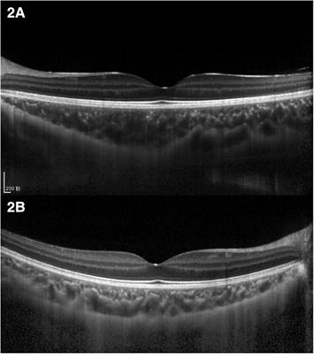 Assessment of choroidal vascularity and choriocapillaris blood perfusion in Chinese preschool-age anisometropic hyperopic amblyopia children